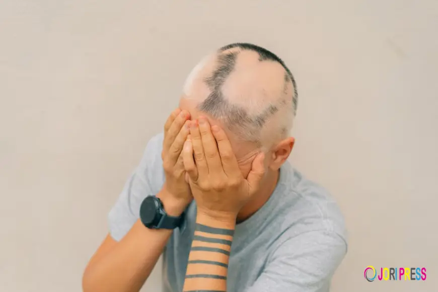 Professional Alopecia Treatment UK Services Gain Attention Through Want Hair Ltd