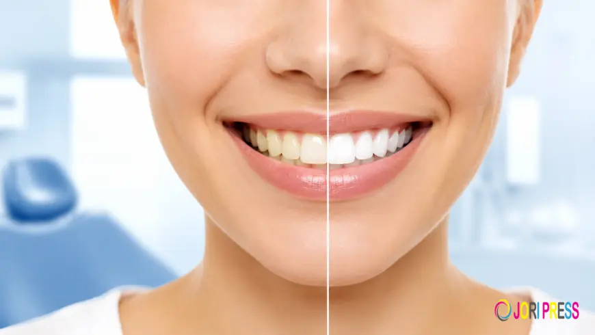Professional Teeth Whitening Services in Sharjah: A Simple Guide to a Brighter Smile