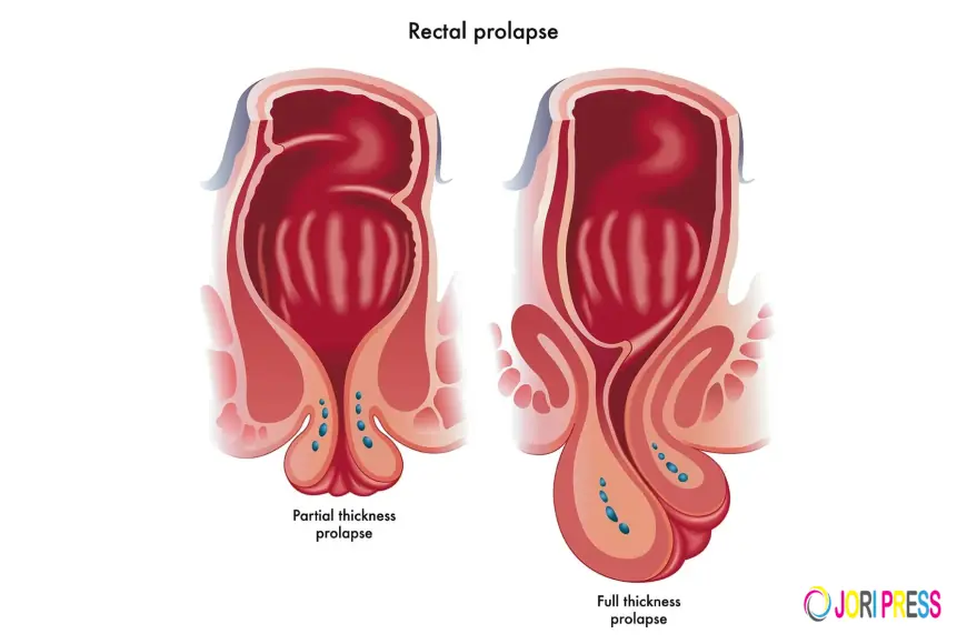 Ayurvedic Treatment for Rectal Prolapse Without Surgery