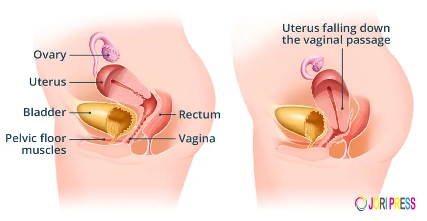 Ayurvedic Treatment for Uterus Prolapse Without Surgery