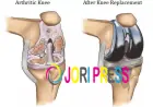 Regain Your Mobility with Expert Total Knee Replacement in Faridabad