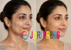 Vitiligo Treatment in Sharjah: Causes, Symptoms & Treatment Options