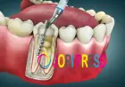 Painless Root Canal Treatment Jaipur | Expert Care by Royalimplants
