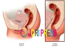 Natural Ayurvedic Treatment for Rectal Prolapse