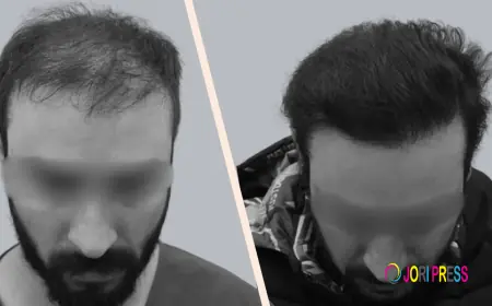 Hair Transplant in India: The Complete 2026 Clinical Guide to Permanent Hair Restoration
