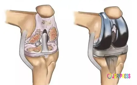 Regain Your Mobility with Expert Total Knee Replacement in Faridabad