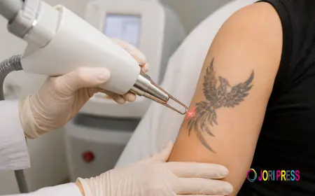 Tattoo Removal in Sharjah: Safe Laser Treatment for Unwanted Tattoos