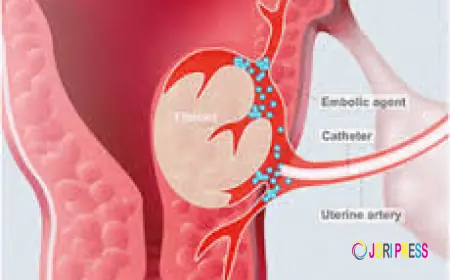 Understanding Uterine Artery Embolization as a Minimally Invasive Treatment for Fibroids