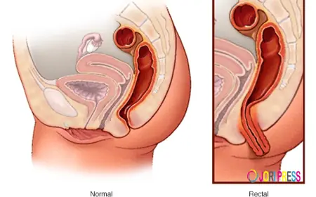Natural Ayurvedic Treatment for Rectal Prolapse