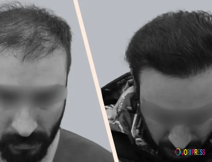 Hair Transplant in India: The Complete 2026 Clinical Guide to Permanent Hair Restoration