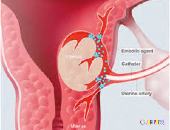 Understanding Uterine Artery Embolization as a Minimally Invasive Treatment for Fibroids