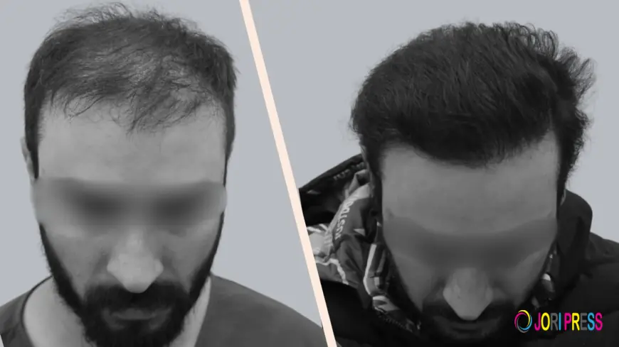 Hair Transplant in India: The Complete 2026 Clinical Guide to Permanent Hair Restoration