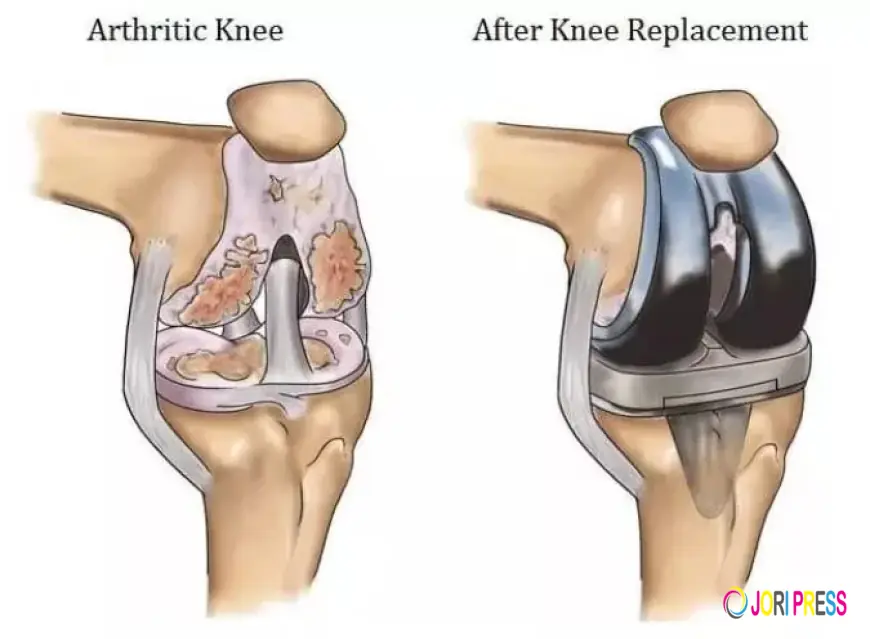 Regain Your Mobility with Expert Total Knee Replacement in Faridabad