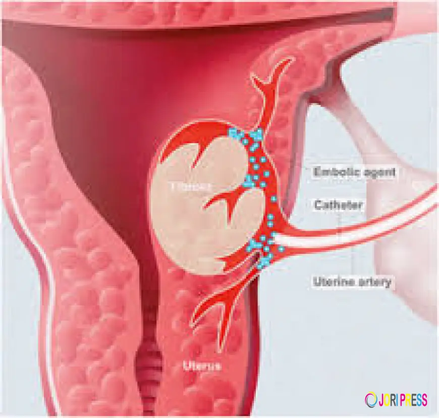 Understanding Uterine Artery Embolization as a Minimally Invasive Treatment for Fibroids