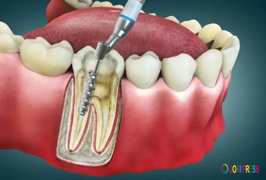 Painless Root Canal Treatment Jaipur | Expert Care by Royalimplants