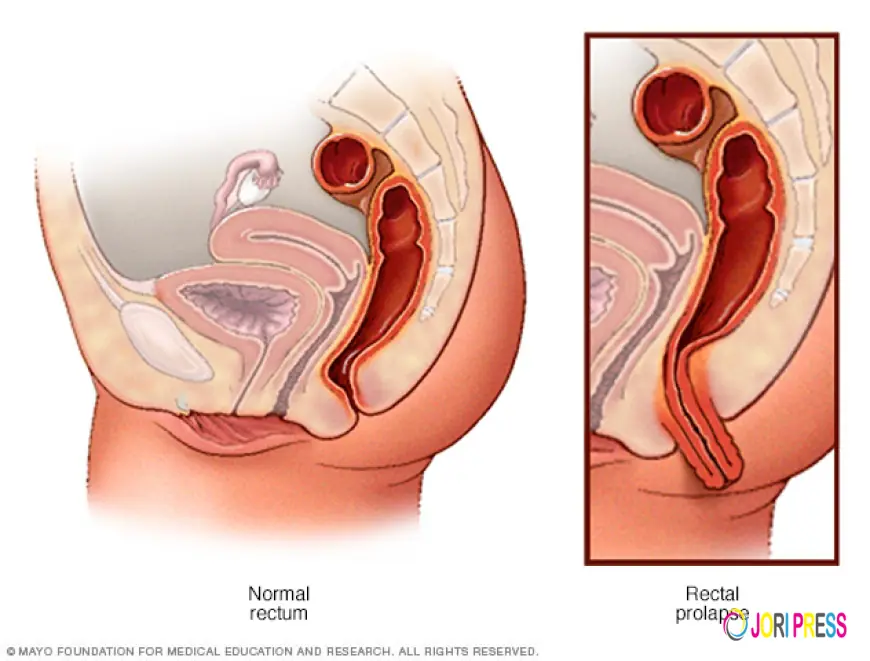 Natural Ayurvedic Treatment for Rectal Prolapse