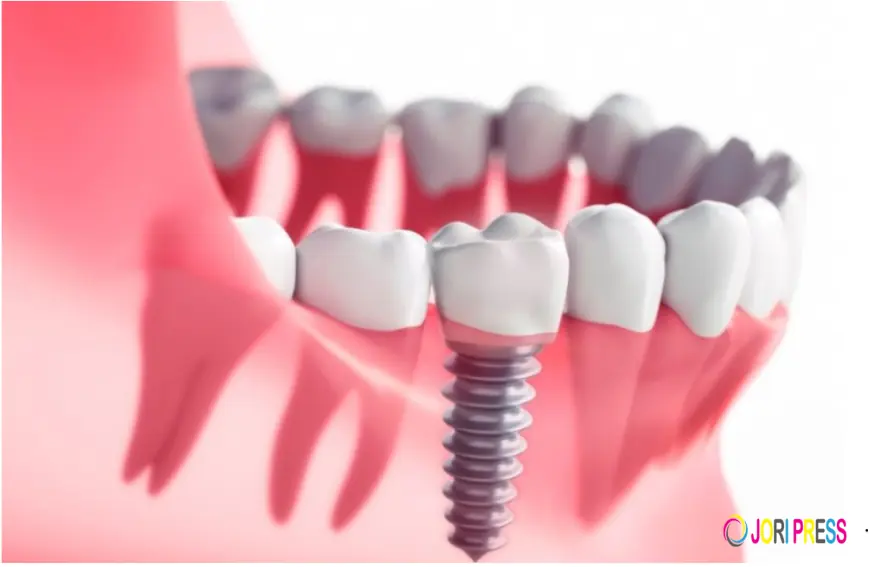 Dental Implants in Boronia — What Local Patients Actually Need to Know Before Booking Anything
