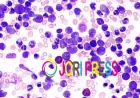 Chronic Myelomonocytic Leukemia Market Size and Emerging Growth Trends