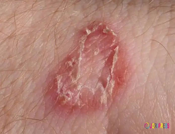 Worm Infection vs Fungal Infection