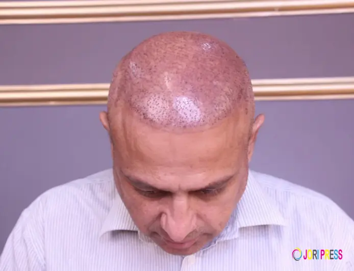 Understanding FUE Hair Transplant: A Modern Solution for Permanent Hair Loss