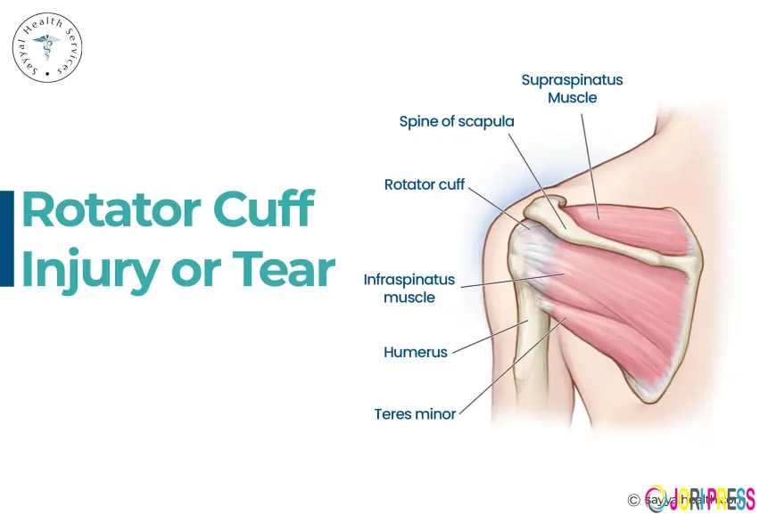 Signs and Symptoms of Torn Rotator Cuff