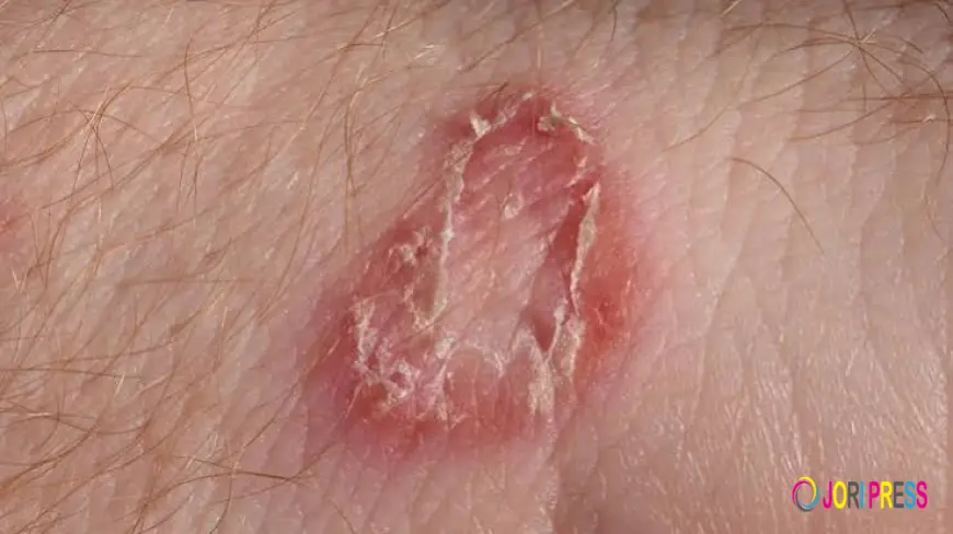 Worm Infection vs Fungal Infection