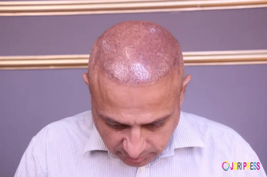 Understanding FUE Hair Transplant: A Modern Solution for Permanent Hair Loss