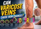 Can Varicose Veins Cause Skin Changes?