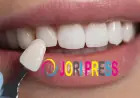 Can You Get Veneers with Crooked Teeth? Here's the Truth