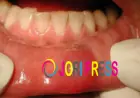 Bump on Lip: Common Causes, Signs & Treatment Options