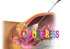 Hysteroscopy Specialist Zirakpur: Understanding the Procedure and Its Benefits
