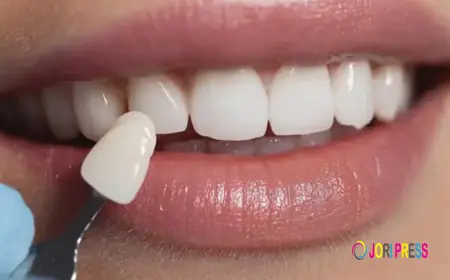 Can You Get Veneers with Crooked Teeth? Here's the Truth