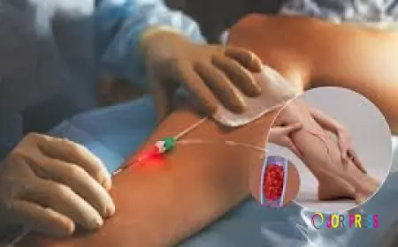 Endovenous Laser Treatment Montreal for Safe and Effective Vein Treatment