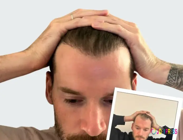 Discover Why Want Hair Ltd Is Becoming a Trusted Name for Best Hair Transplant in Turkey