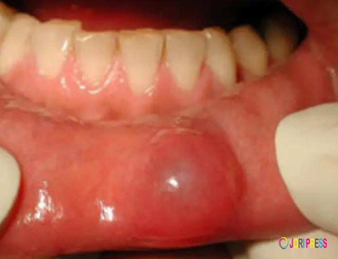 Bump on Lip: Common Causes, Signs & Treatment Options