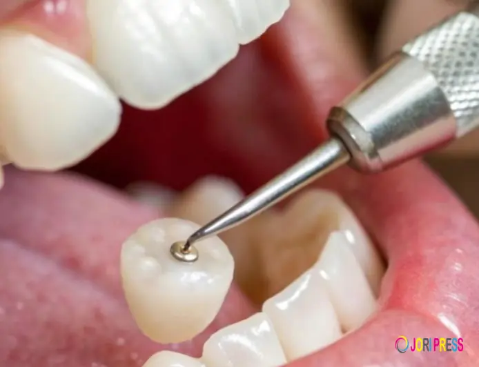 Price of Dental Cap: Full Cost & Types Guide