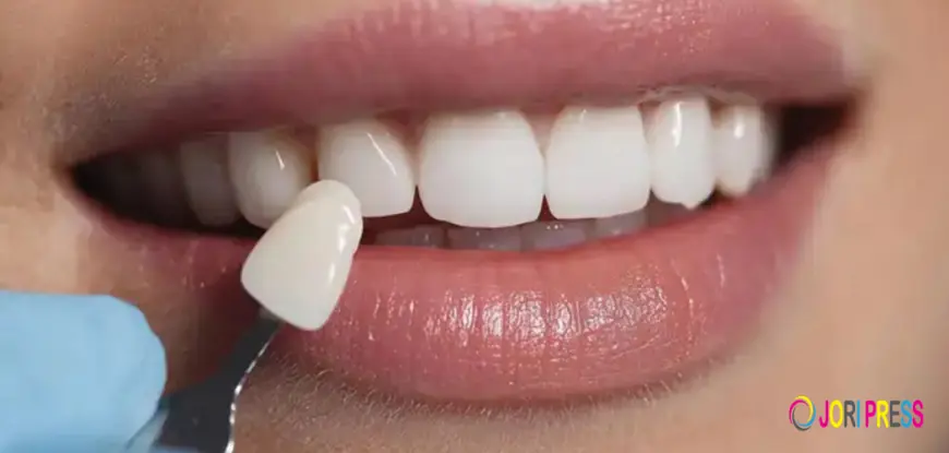 Can You Get Veneers with Crooked Teeth? Here's the Truth