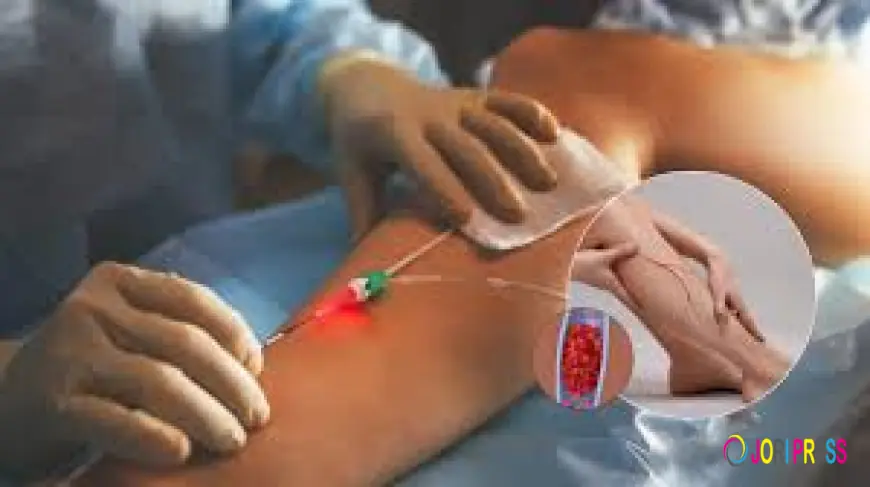 Endovenous Laser Treatment Montreal for Safe and Effective Vein Treatment