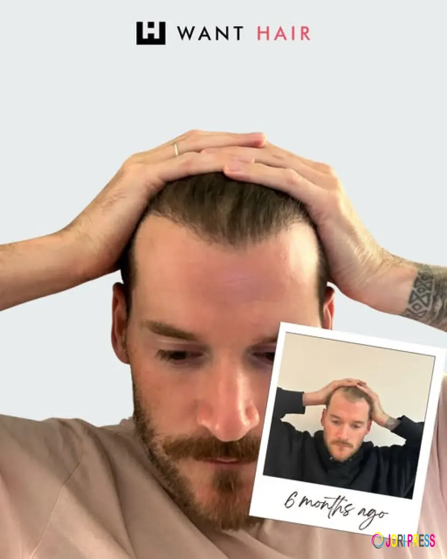 Discover Why Want Hair Ltd Is Becoming a Trusted Name for Best Hair Transplant in Turkey