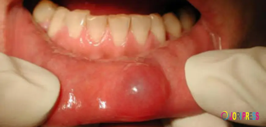 Bump on Lip: Common Causes, Signs & Treatment Options
