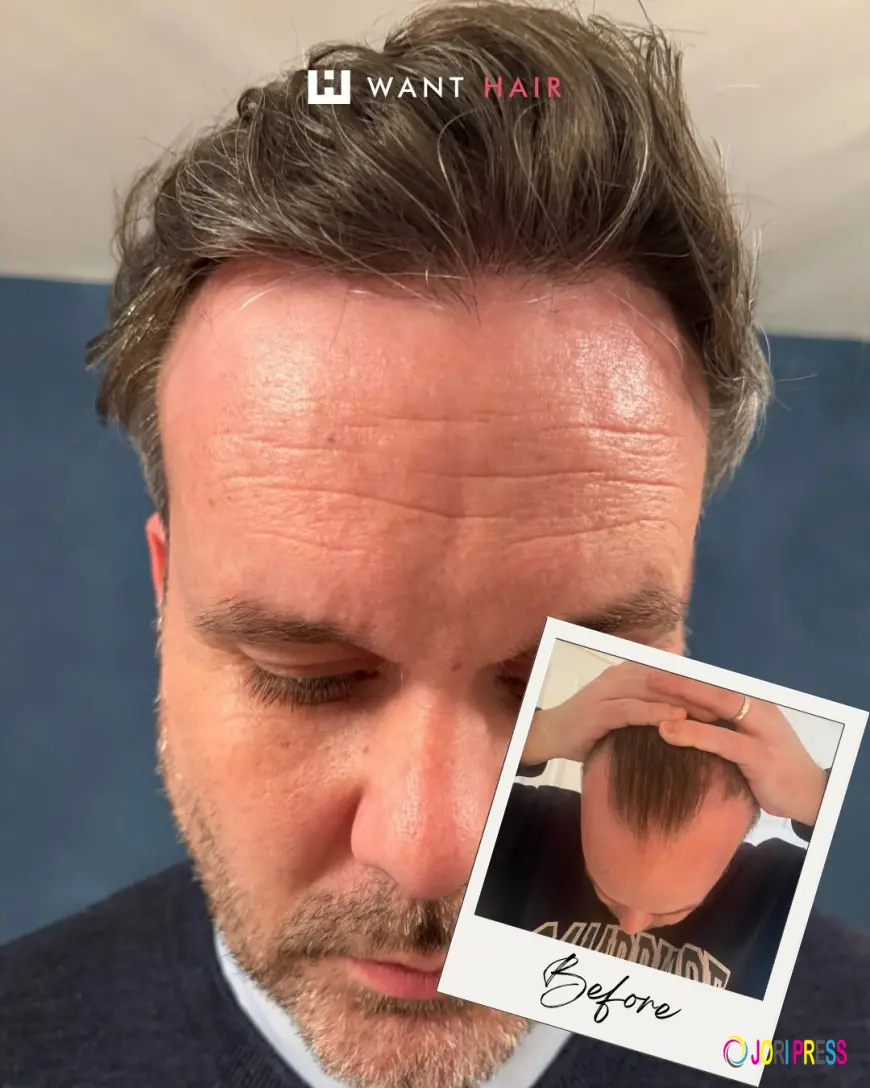 Want Hair Helps Clients Discover Professional Solutions for the Best Hair Loss Treatment in UK