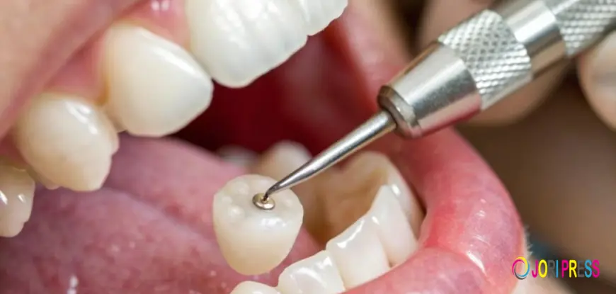 Price of Dental Cap: Full Cost & Types Guide