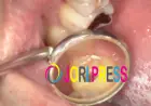 Cracked Tooth Root: Causes, Symptoms, Diagnosis & Treatment