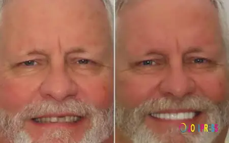 How Can Class 1 Veneers Restorations Support Non-Surgical Chin Enhancement?