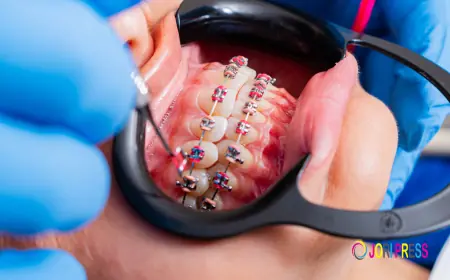 Monticello Braces: What Should You Know Before Starting Treatment?