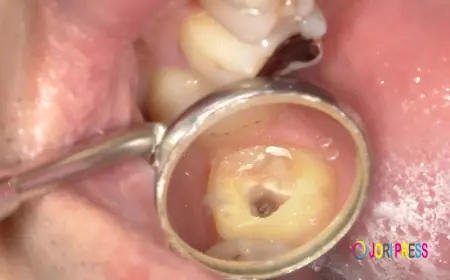 Cracked Tooth Root: Causes, Symptoms, Diagnosis & Treatment