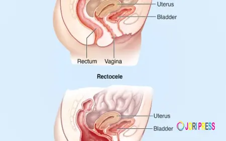 Ayurvedic Care for Prolapsed Rectum