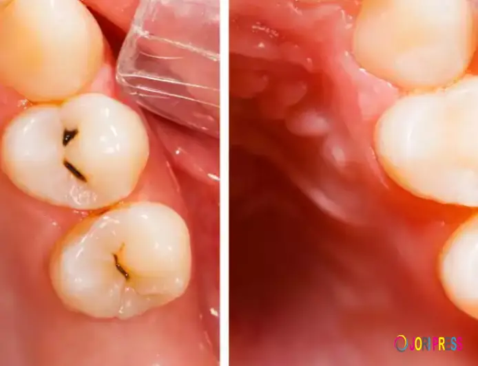 Sensitive Teeth After Filling? Causes, Relief & When to Worry