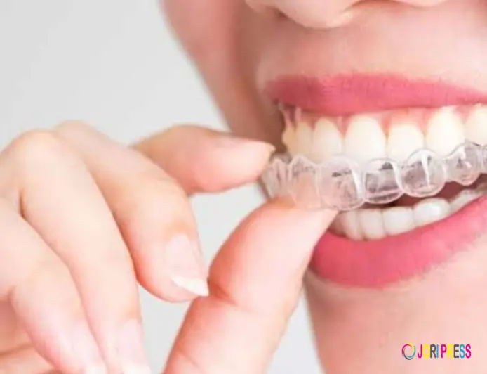 Elegant Smiles Offers SimplyClear Aligners in Atlanta for a Discreet Approach to Teeth Straightening