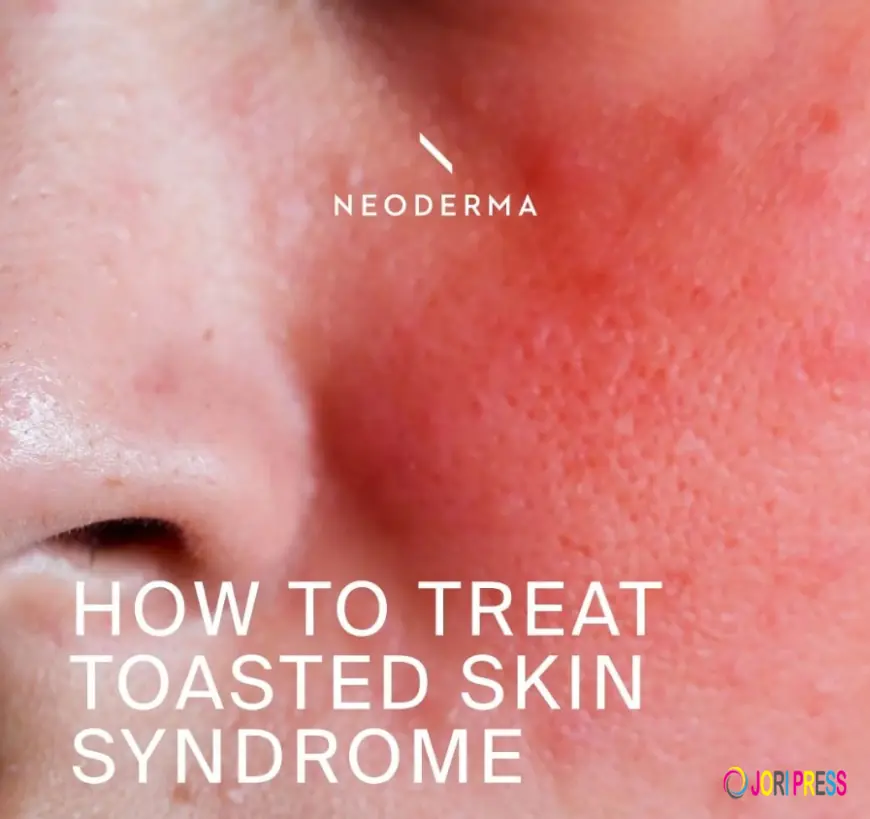 Heat Rash on Face: Causes, Symptoms, Treatment, and Prevention